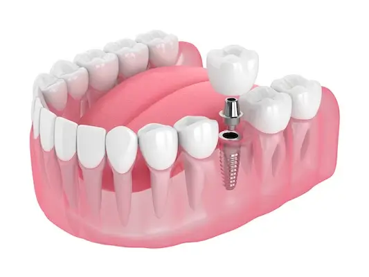 Dental Implants Danville | Top Dental Implant Surgeon Danville | Diablo Valley Implant Dentistry